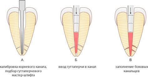 Этапы применения горячей гуттаперчи в стоматологии