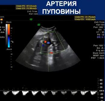  Какие проблемы могут возникнуть при формировании пуповины 3 сосуда на 20 неделе беременности? 