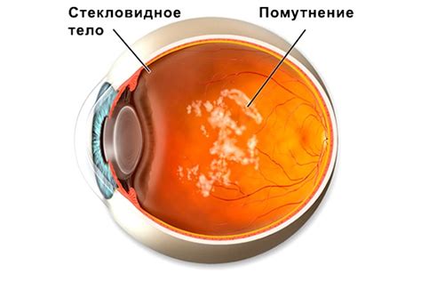  Причины расплывчатого зрения 