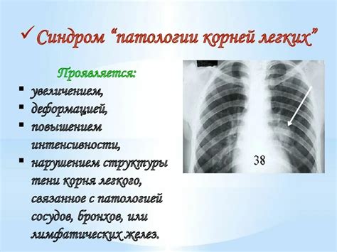  Распространенность расширенного корня легких 