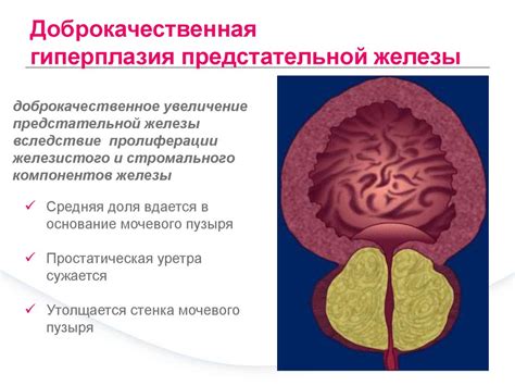  Что такое междолевая борозда предстательной железы? 