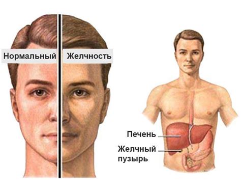  Что такое синдром Жильбера?