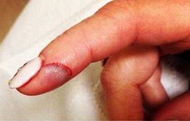 Глубокий порез указательного пальца