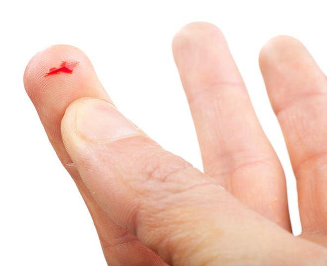 Мелкий порез на указательном пальце