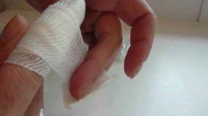 Перевязка травмированного пальца бинтом